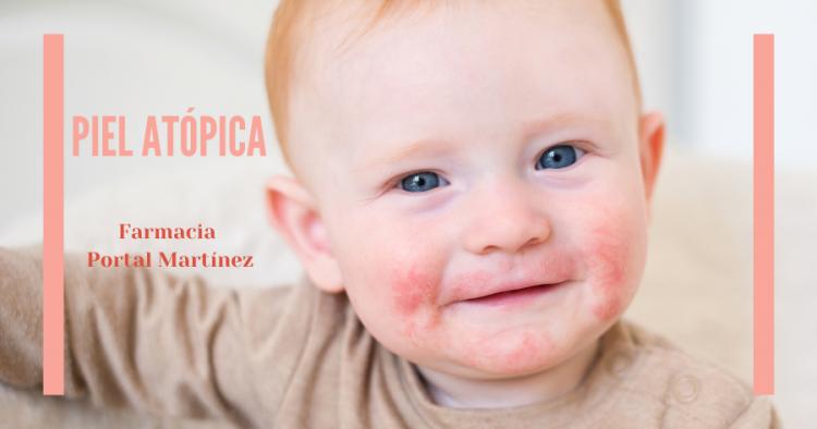 Todo sobre la piel atópica: te ayudamos a espaciar y atenuar los brotes