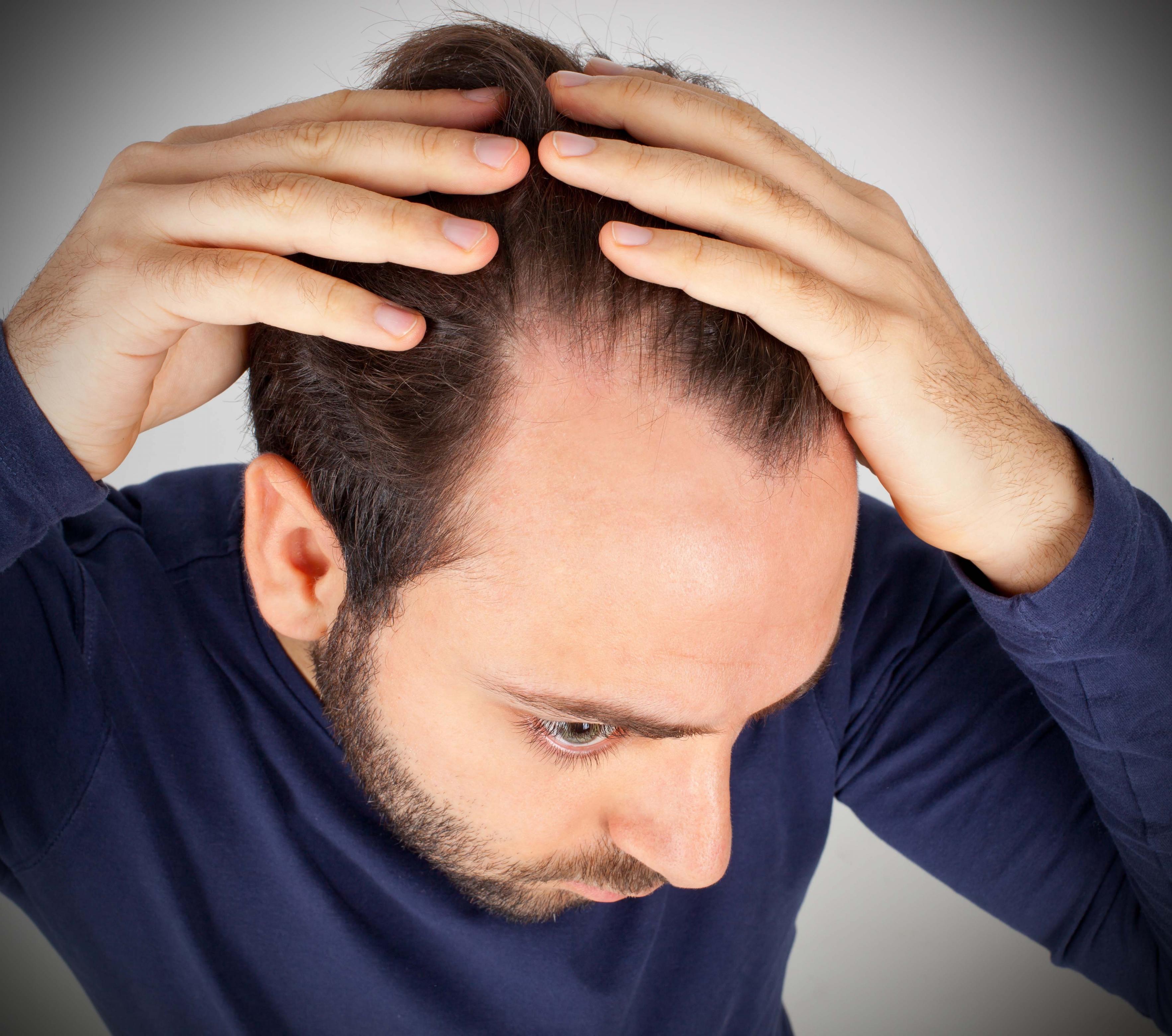 ¿Qué hago para eliminar la caspa?